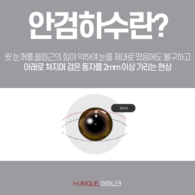 Where is the Most Natural Place to Improve Ptosis Without Double Eyelids? image 2