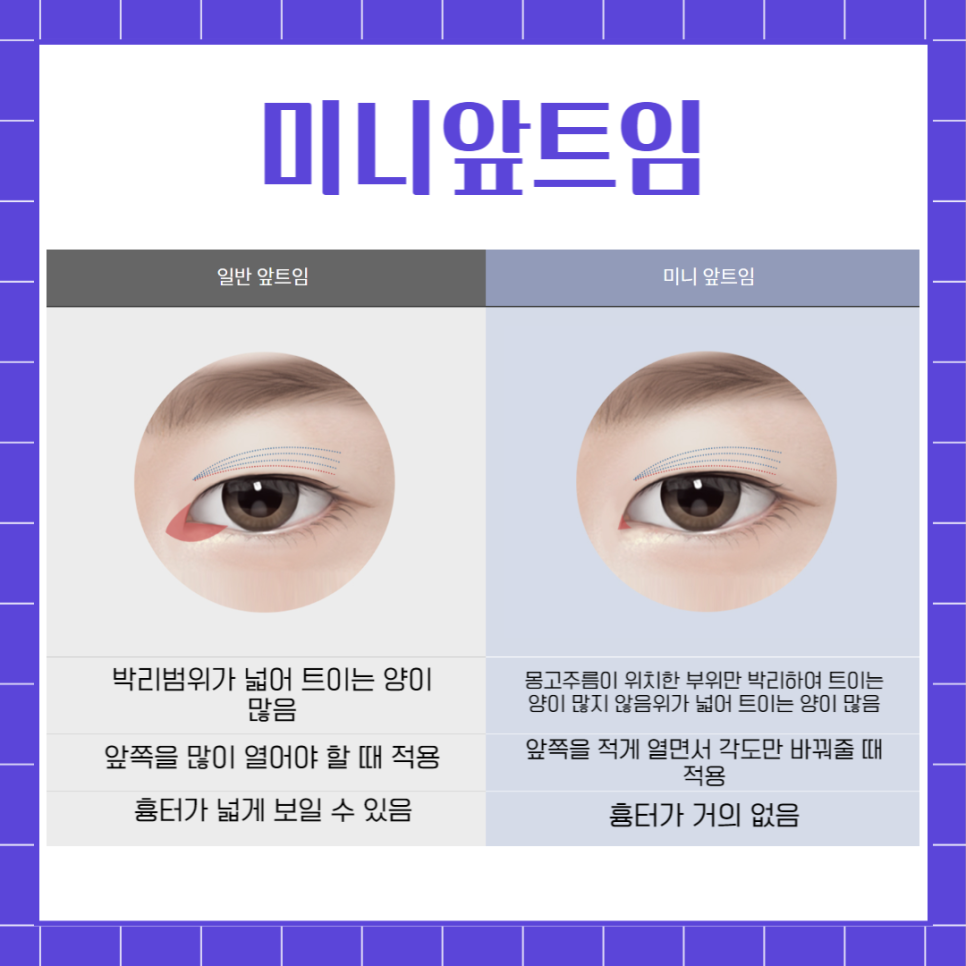 Upper Epicanthoplasty Effects: Significantly Improve a Heavy-Looking Eye Shape! image 4