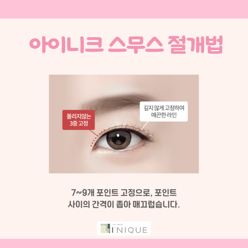 자연스러운 쌍수를 위한 중요한 점 관련 이미지 2