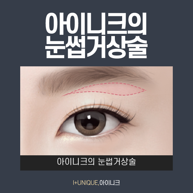 나! 다시 돌아갈래~ 중년 눈 성형, 눈썹거상술 관련 이미지 4