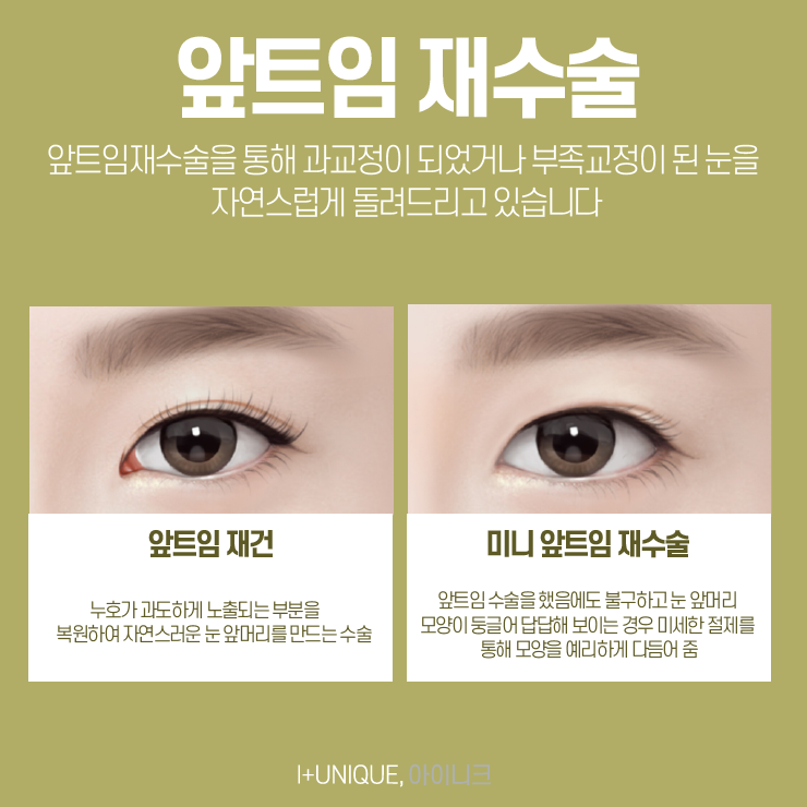 앞트임수술 알아보고 있다면 내 눈을 철저하게 분석해 주는 곳으로! 관련 이미지 4
