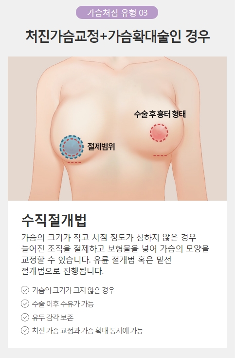 처진가슴수술비용 정확하고 꼼꼼한 맞춤 상담! 아이니크 성형외과! 관련 이미지 5