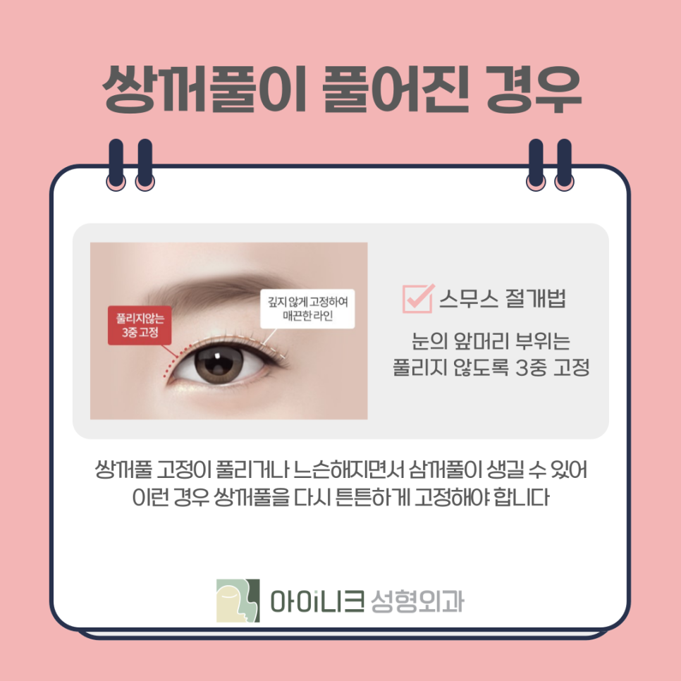눈재수술로 삼꺼풀 부작용 해결하기 관련 이미지 7