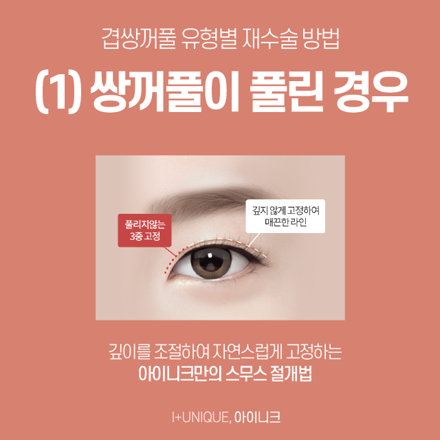 Double Eyelids with Multiple Folds, Also Called “Three-Fold Eyelids”! If You’re Worried About It, Here’s How to Improve It image 3