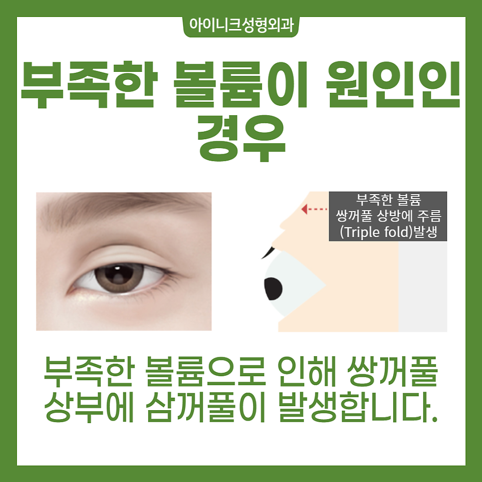 Double Eyelid Revision Surgery: You Need to Understand the Cause to Solve It! image 5