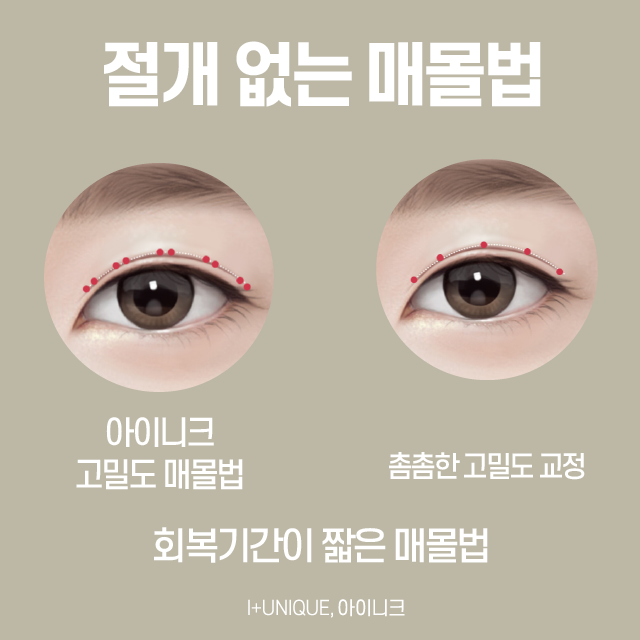 안검하수재수술은 어디서? 관련 이미지 4