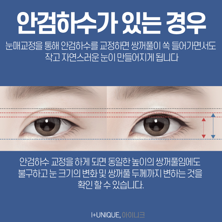 소세지쌍꺼풀이 고민이라면 아이니크성형외과를 오면 답이 있다 관련 이미지 4
