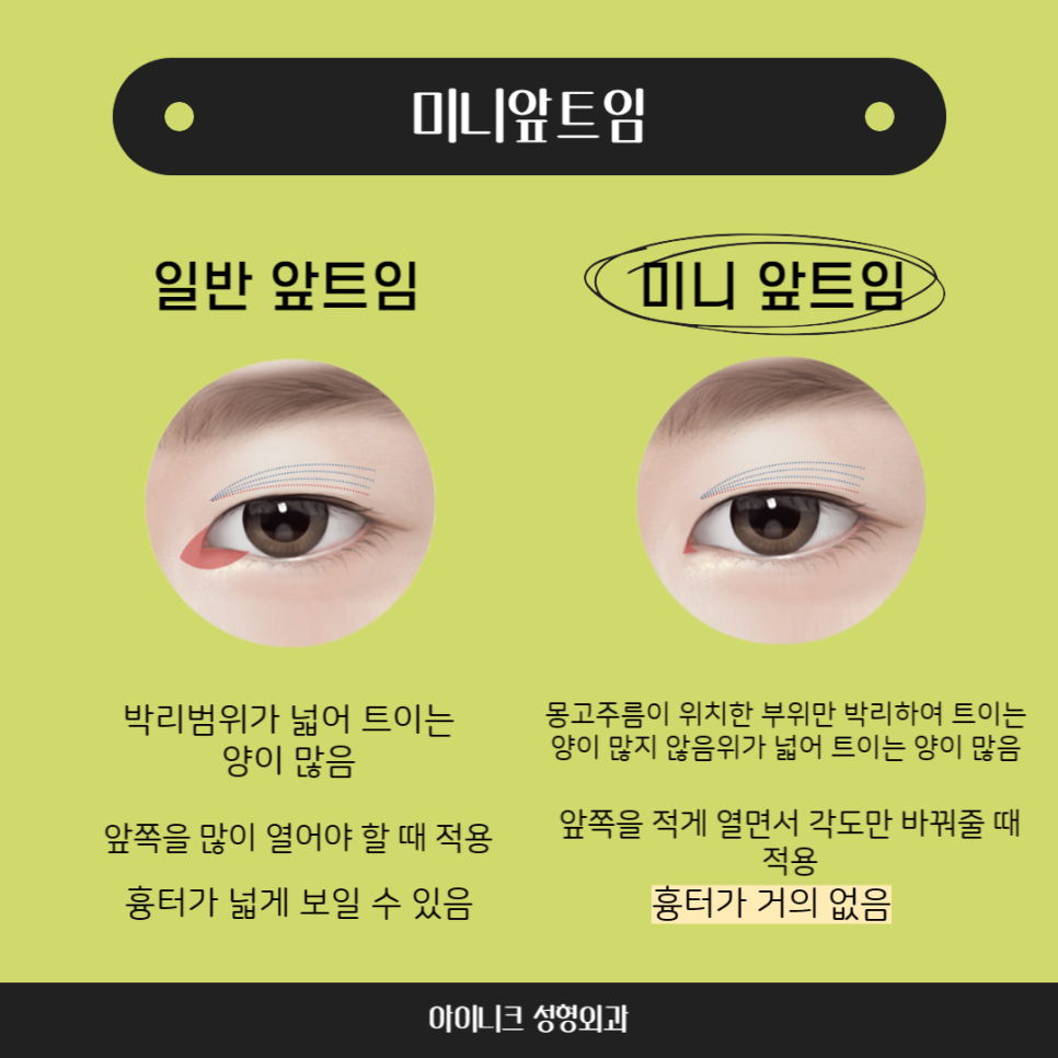 강남앞트임 주저말고 아이니크로! 관련 이미지 3