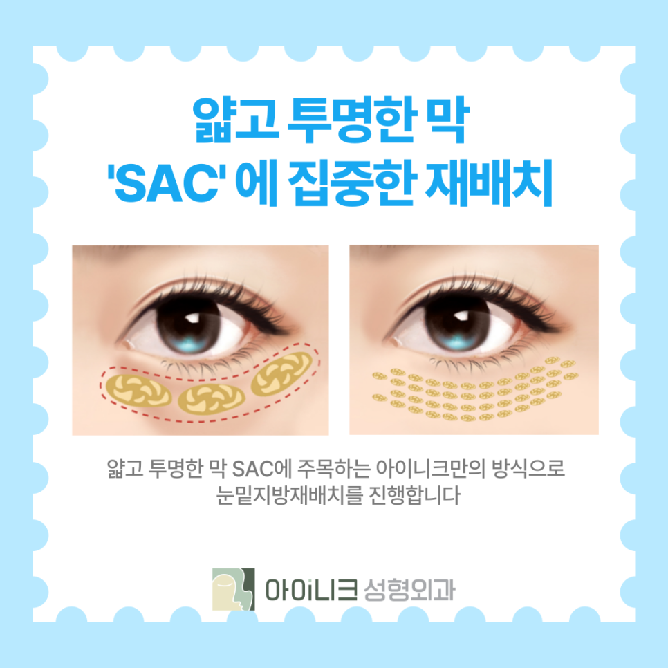 Creating a Brighter Impression with Lower Eyelid Fat Repositioning for Middle-Aged Adults image 7