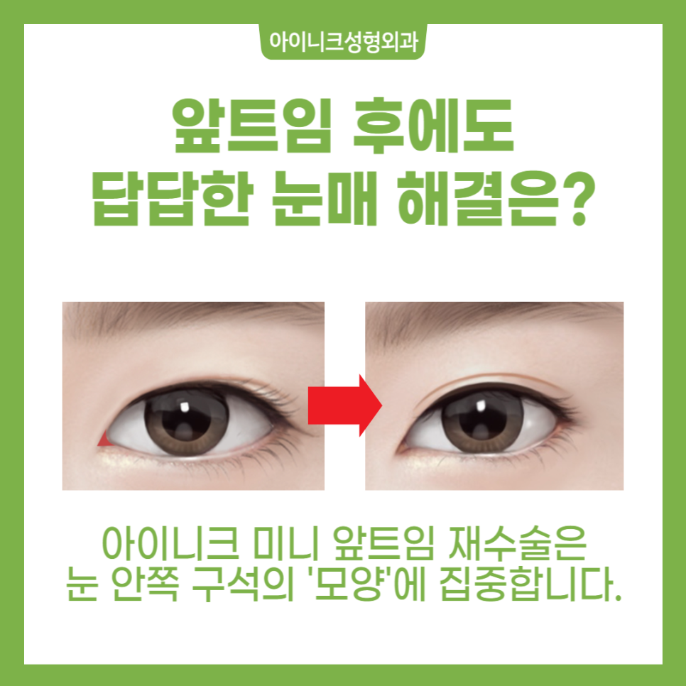 앞트임 재건 수술 경험 많은 병원에서 안전하게, 자연스럽게 관련 이미지 4