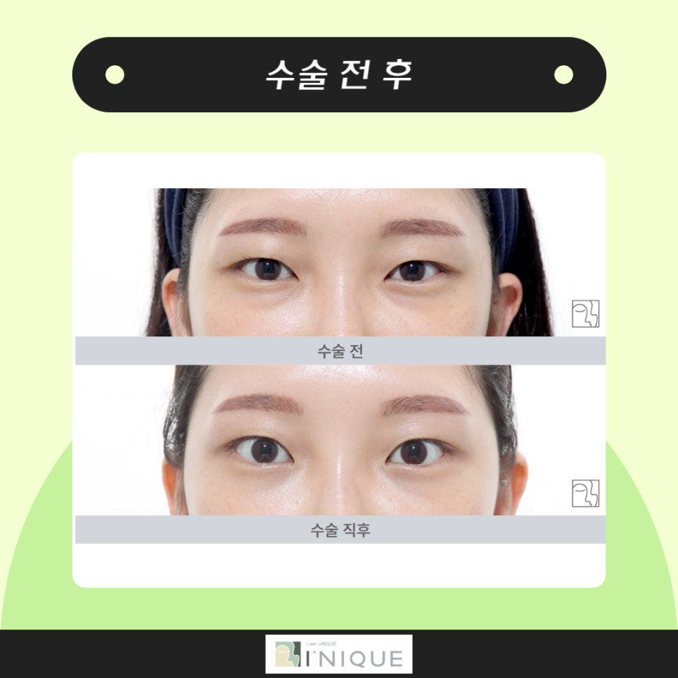 눈밑지방재배치수술로 다시 20대의 눈매로 관련 이미지 4