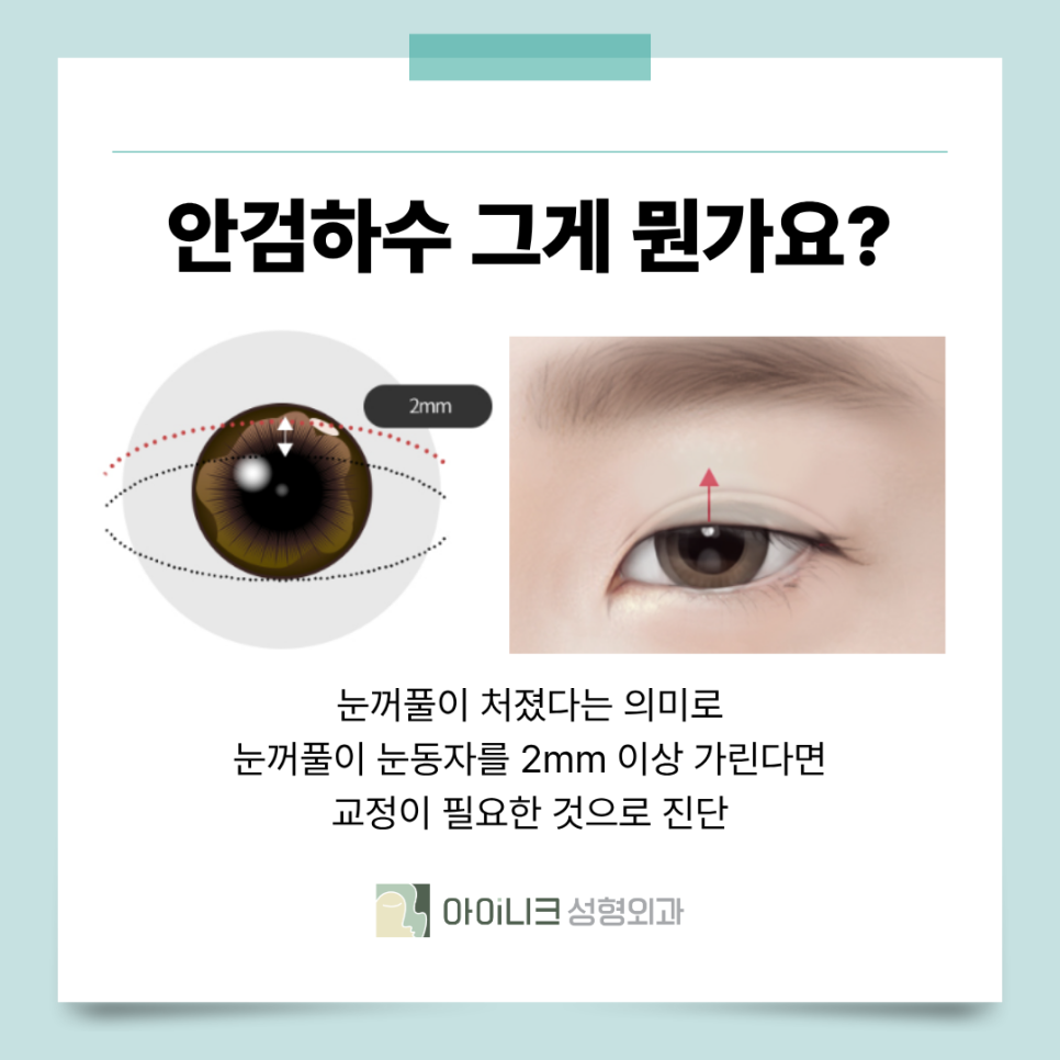 서울안검하수 눈꺼풀에 덮혀서 답답한 눈이라면? 관련 이미지 4