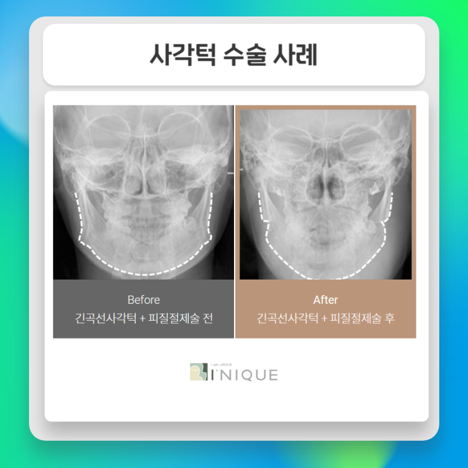 Key Points of Facial Contouring Surgery image 6