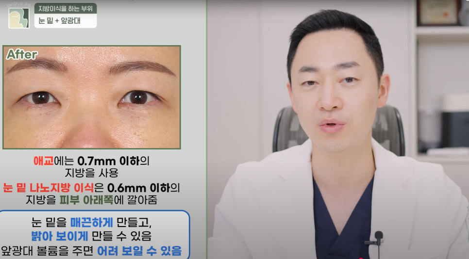 Look Younger with Gangnam Encore Under-Eye Fat Grafting! image 10