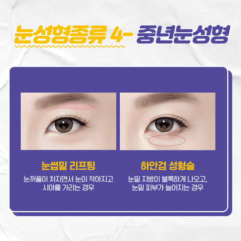 눈성형종류 중에 내게 맞는 방법은? 관련 이미지 5