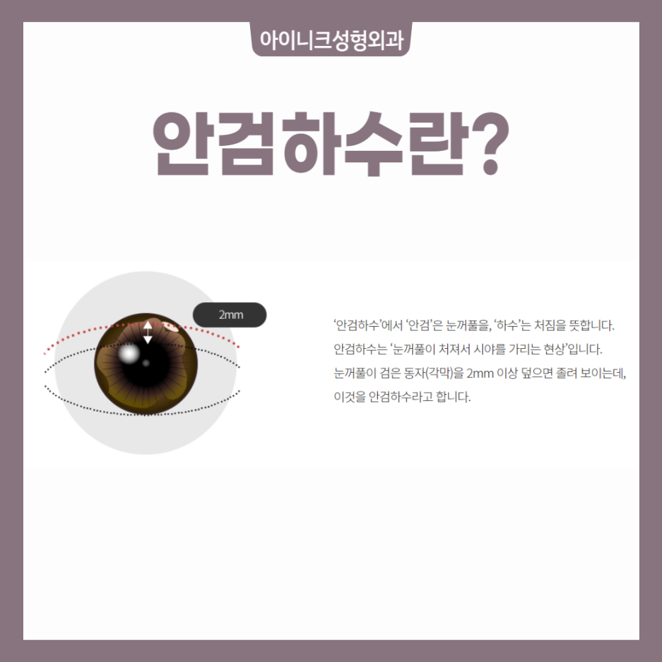 안검하수눈매교정 비절개 방식과 절개 방식 장단점과 추천 대상 관련 이미지 2