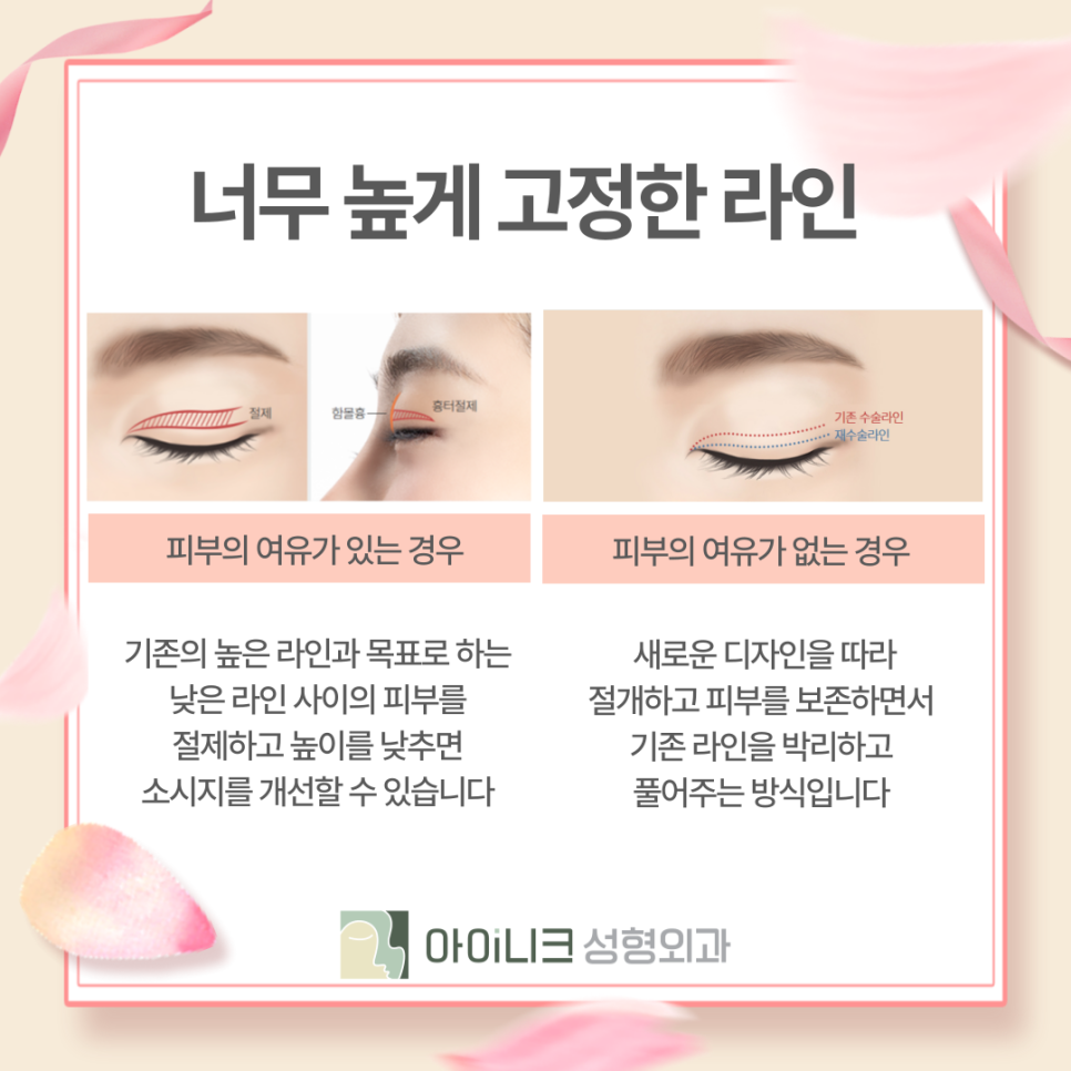쌍수재수술병원 부담스러운 소시지눈 개선하기 관련 이미지 9