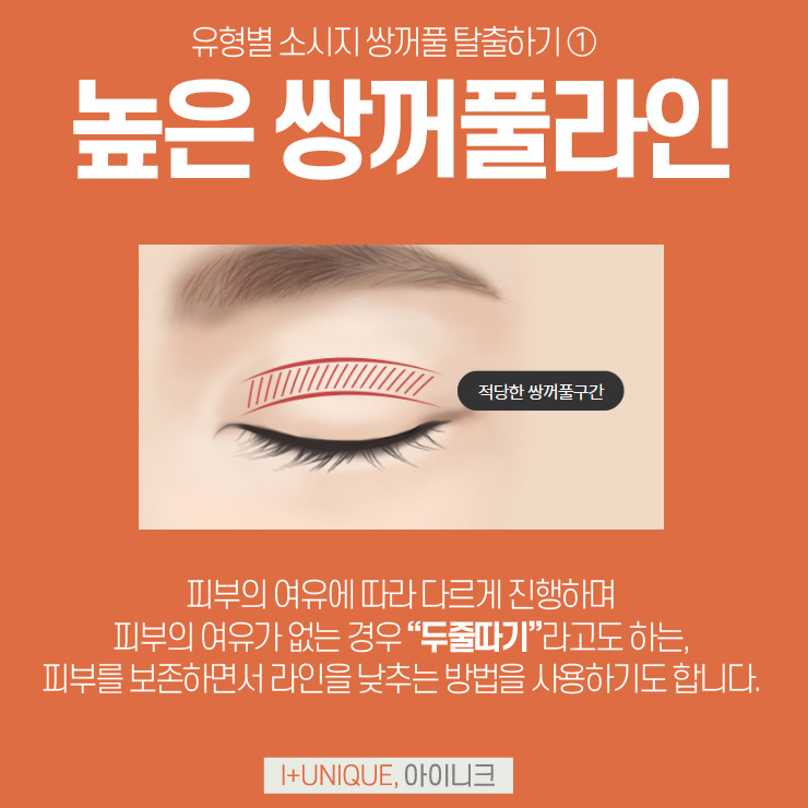쌍수잘하는병원 아이니크성형외과 관련 이미지 4