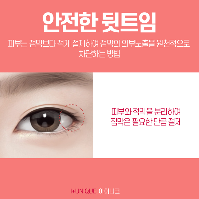 강남눈성형외과에서 트임수술을 원한다면 아이니크에서 알아보자 관련 이미지 4