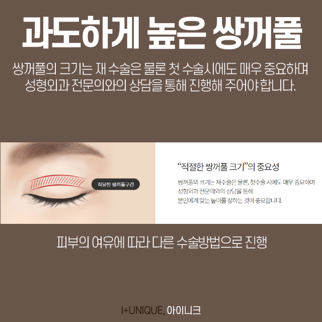 소세지쌍꺼풀, 더이상 속상한 채로 두지말고 아이니크성형외과로 관련 이미지 3