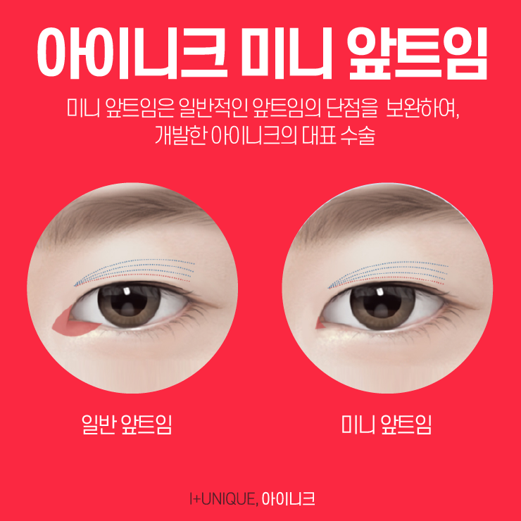 서울눈성형외과를 알아본다면, 신중한 결정이 필요하다 관련 이미지 4