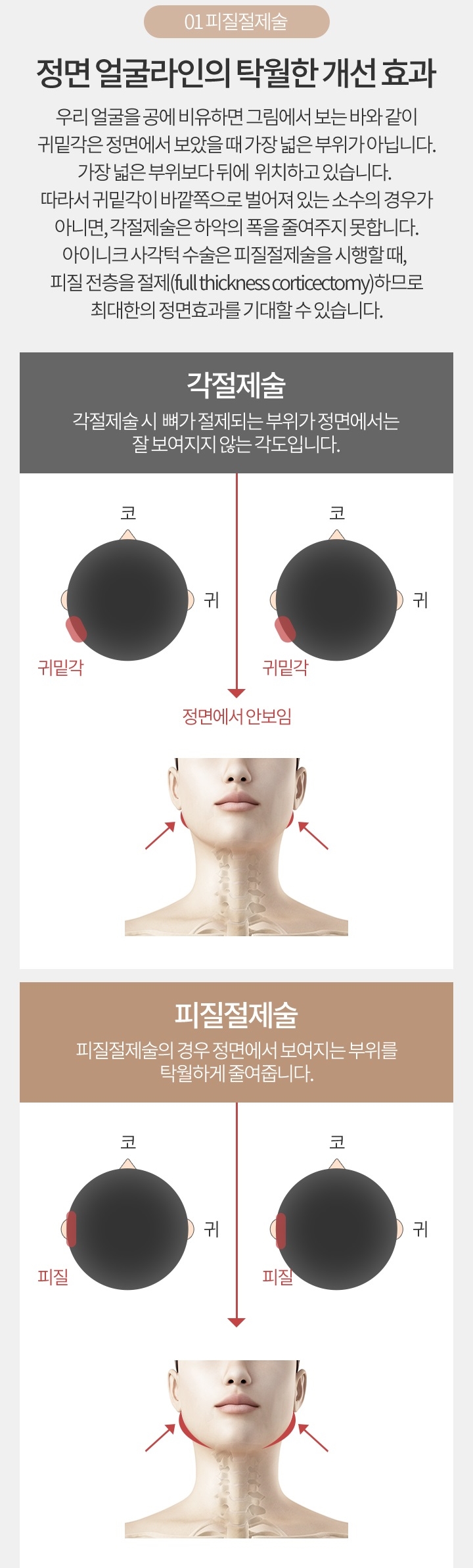 피질절제술로 정면에서도 V라인 관련 이미지 3
