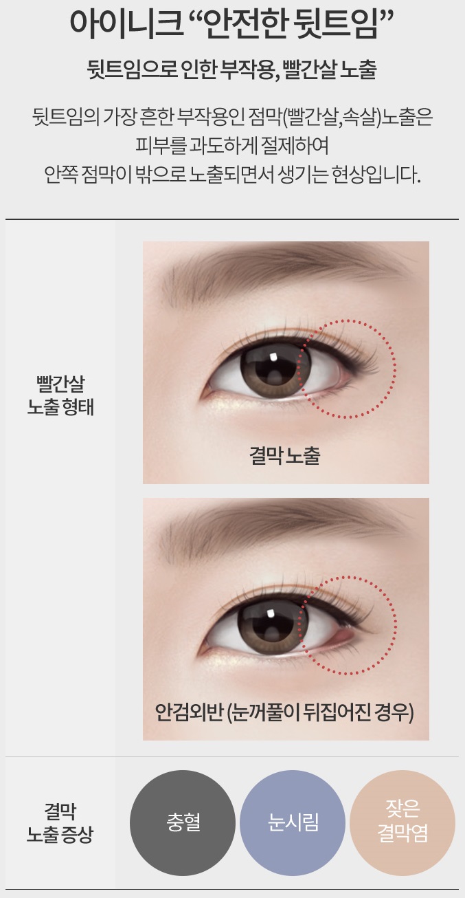 뒤트임복원 아이니크를 찾는 이유 관련 이미지 3