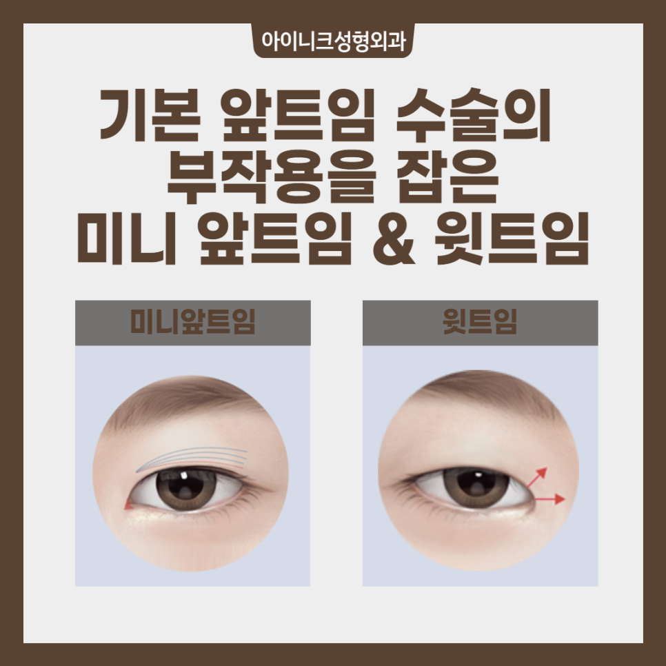 180도 이미지 변신? 압구정트임 수술 관련 이미지 3