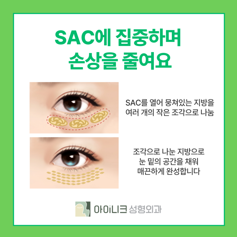 눈밑지방재배치잘하는곳 발생 요인과 개선방법은? 관련 이미지 9