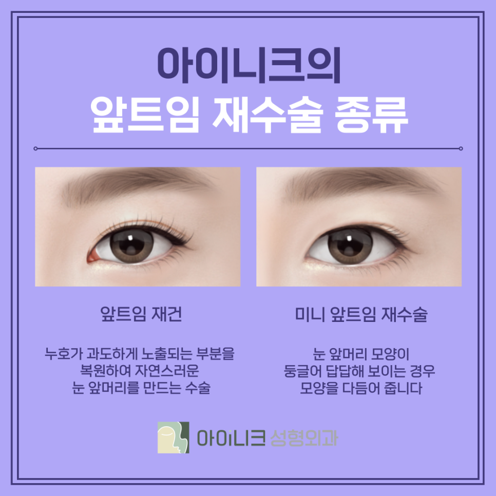 압구정눈재수술잘하는곳 실패를 성공으로 바꾸기 관련 이미지 6