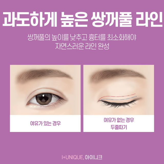 눈재수술 잘하는 곳 신중하게 선택해야하죠! 관련 이미지 3