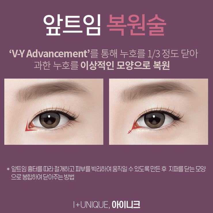 앞트임재건수술 더이상 망설이지 말고 아이니크성형외과로 가자 관련 이미지 3