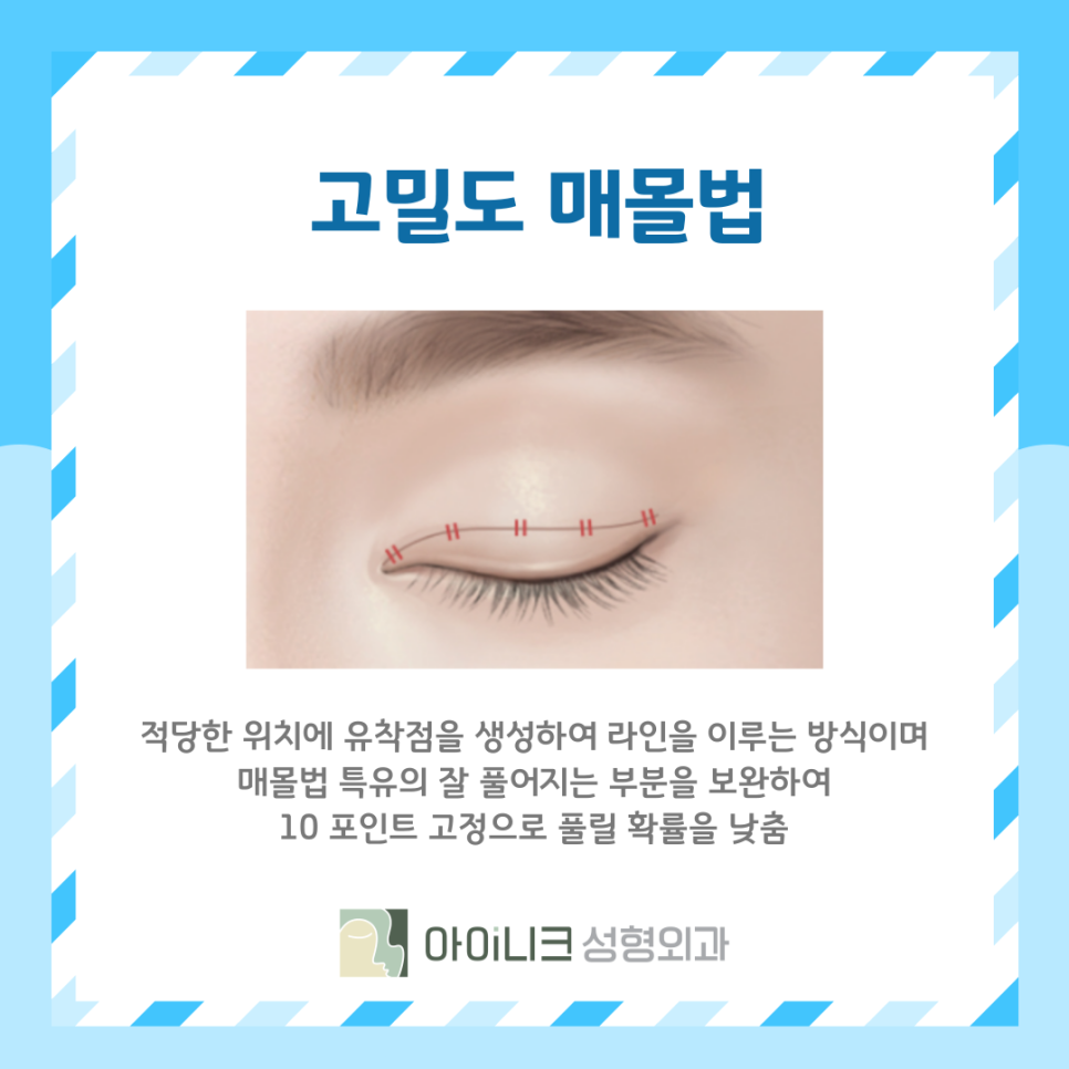 What Is the Right Choice Among Double Eyelid Surgery Types: Suture or Incisional? image 8