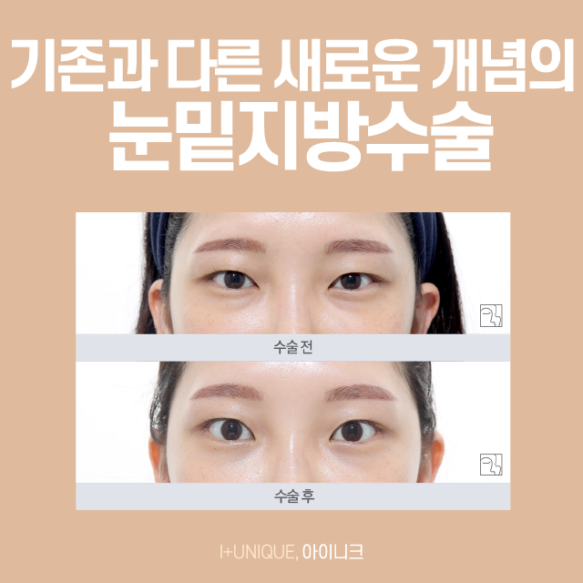 Don’t Worry About Dark Circles Anymore! Learn About the Price of Dark Circle Surgery image 2