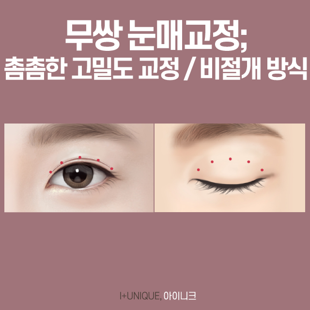 남자 눈 성형 인아웃라인 수술부터 눈매교정까지 관련 이미지 5