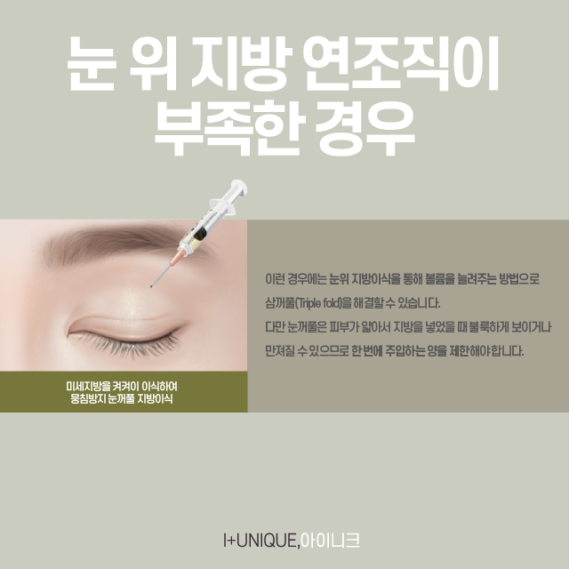 삼꺼풀 해결방법 궁금하다면? 관련 이미지 4
