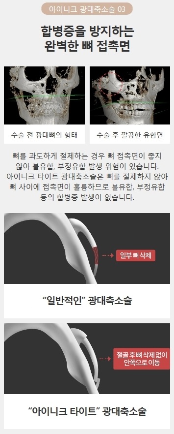 광대축소술가격 합리적인 곳 관련 이미지 5