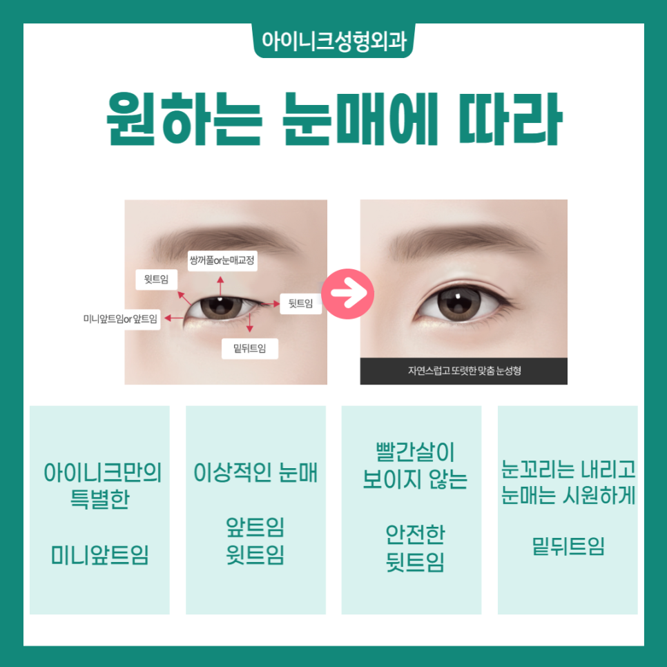 Various Canthoplasty Procedures: Which Design Suits Me Best? image 2