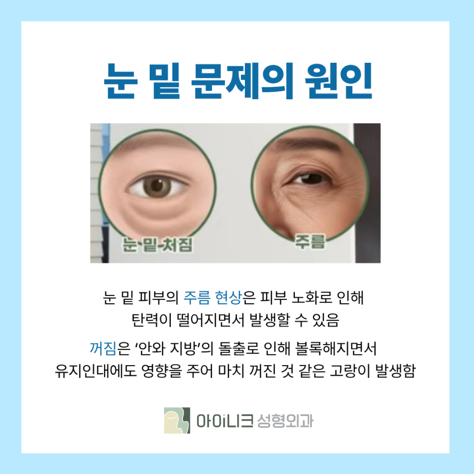 How to Get Rid of Under-Eye Fat: Which Method Should You Choose? image 3