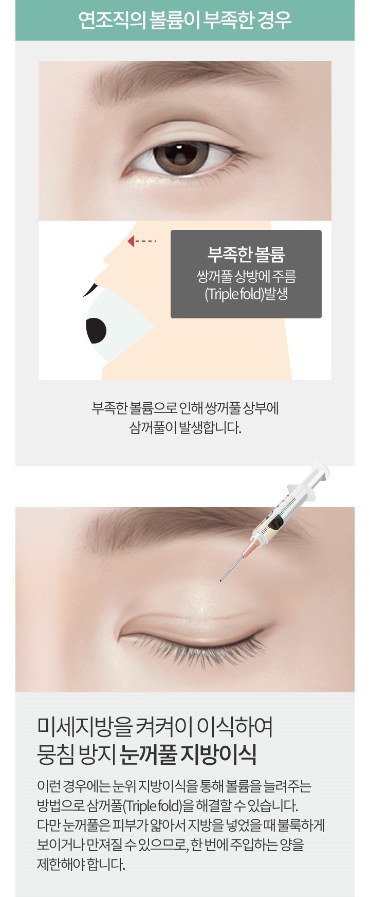 눈꺼풀지방이식비용 자연스러운 눈매로 변신 관련 이미지 5