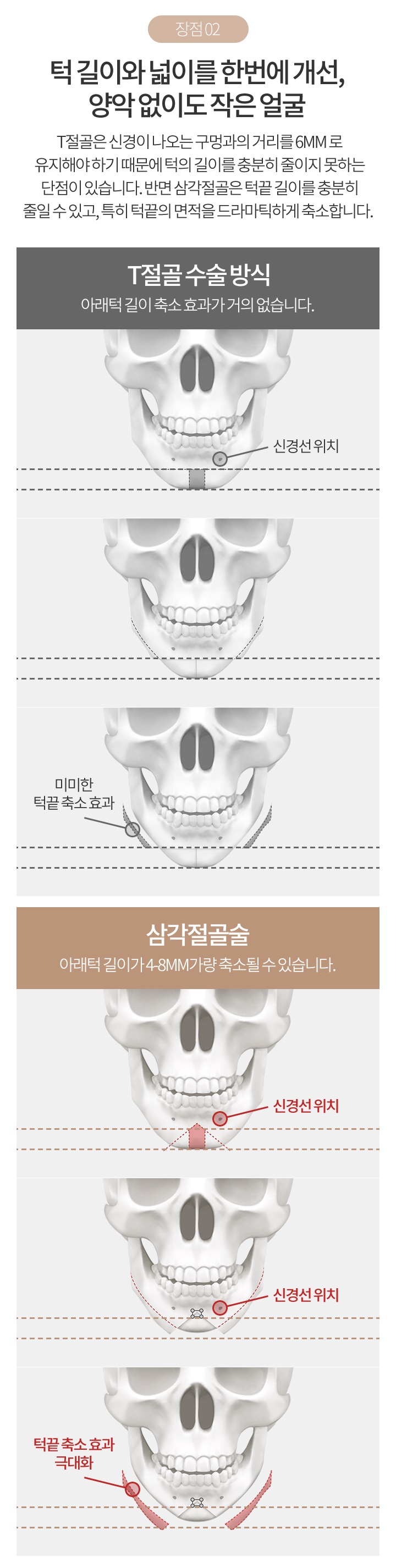 턱끝축소술비용 분위기에 맞는 얼굴형으로 개선 관련 이미지 4