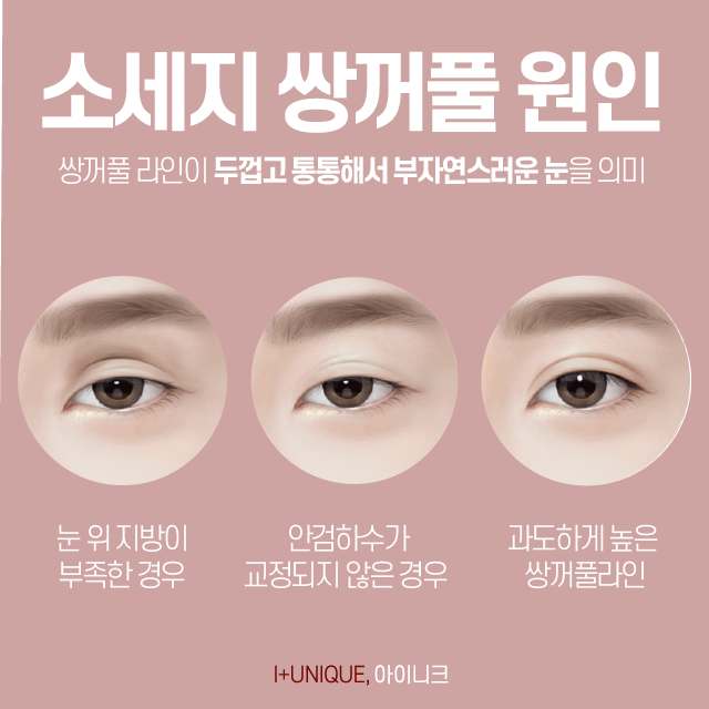 강남쌍꺼풀재수술 알아보고 있다면, 합리적인 선택을! 관련 이미지 2