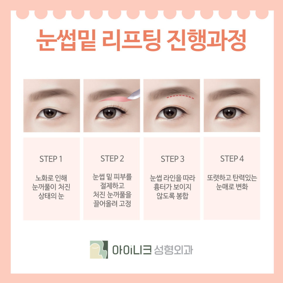 How to Turn Back Time with Eyelid Revision Surgery in Seoul for Middle-Aged Patients image 6