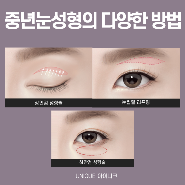 중년눈성형방법, 안전하고 완벽하게! 관련 이미지 2