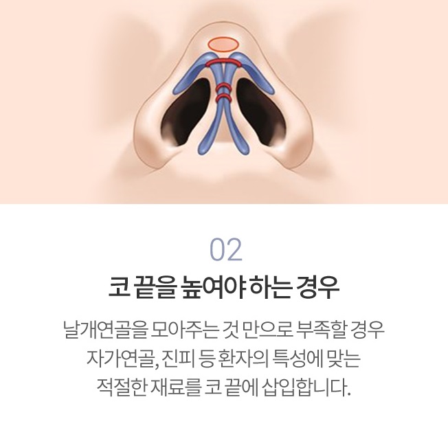 비개방코끝성형으로 처음부터 예뻤던 것처럼 관련 이미지 4