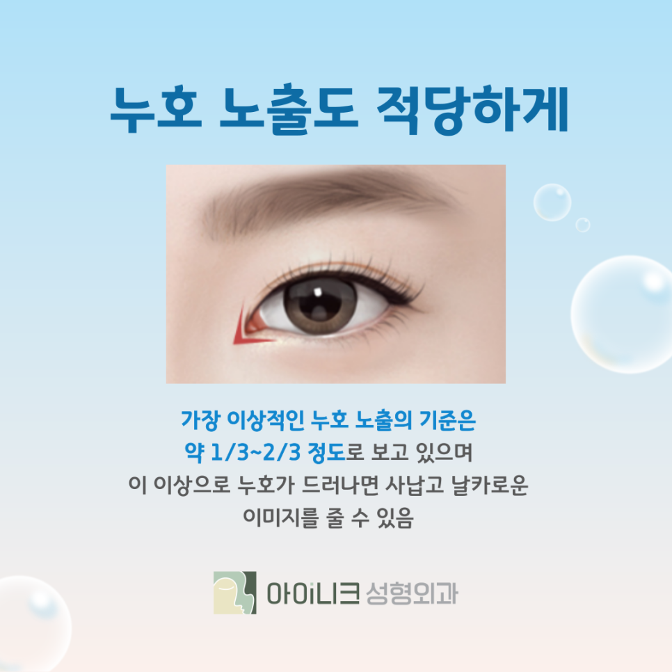 눈 트임 성형 꽉 막힌 몽고주름 개선하는 방법 관련 이미지 10