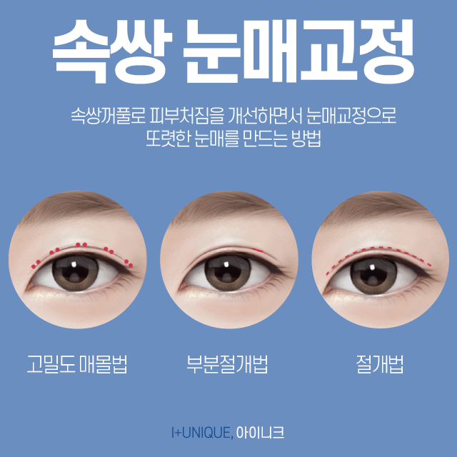 남자눈매교정수술로 남성의 눈에 맞는 디자인을! 관련 이미지 3