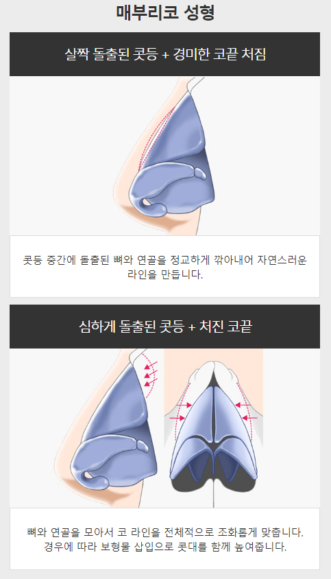 메부리코수술전후 매력적인 라인과 부드러운 인상으로! 관련 이미지 3