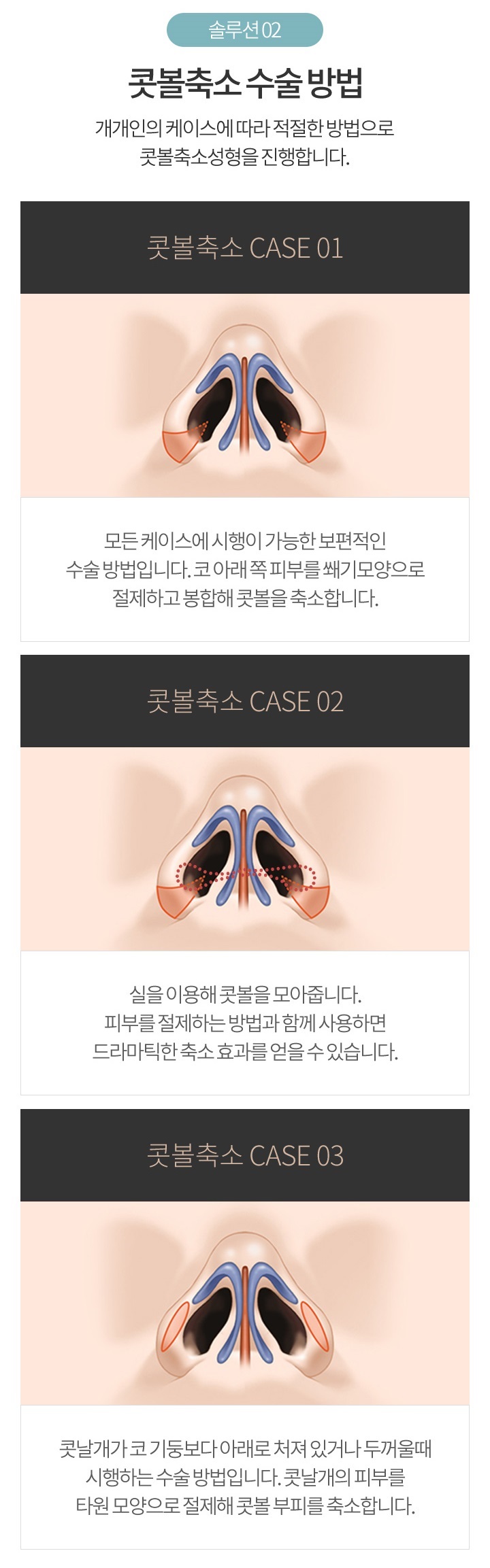 콧볼축소가격 합리적인 아이니크에서 자연스럽게! 관련 이미지 4