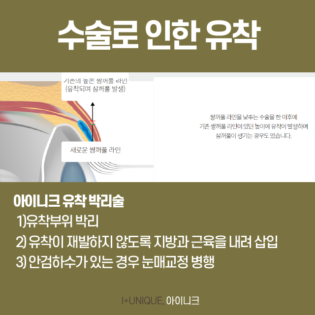 삼꺼풀해결방법, 원인 파악부터 제대로! 관련 이미지 5